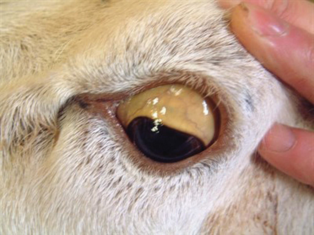 Jaundice is seen here on the sclera of the eye.