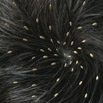 head lice