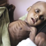 Severely malnourished young child.