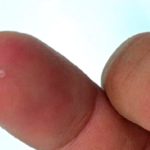 An adult Thelazia gulosa removed from the eye of a human and shown here on a person’s finger. (CDC.gov)
