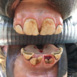 This three-year-old filly has two upper permanent central incisors and has just recently lost the “caps” of her lower central incisors revealing the erupting adult teeth. Within the next few months her four central incisors will be in full wear against one another.